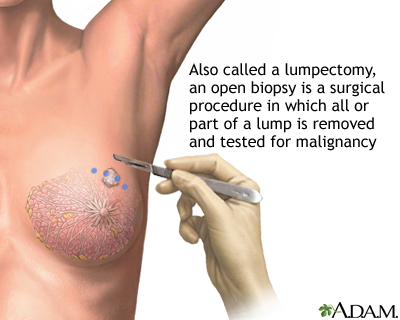 Breast lump removal Breast cancer Breast biopsy. Reviewed By: Harvey Simon, 