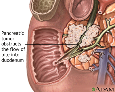gallbladder disease. bile in the gallbladder.